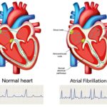 Atrial fibrillation