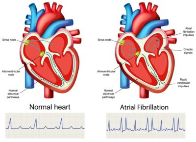 comparison-normal-heart-atrial-fibrillation_1308-182649 comparison-normal-heart-atrial-fibrillation_1308-182649