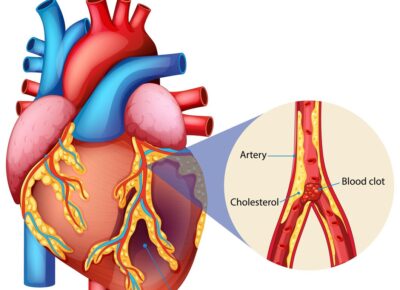 detailed-heart-attack-medical-illustration_1308-182606 detailed-heart-attack-medical-illustration_1308-182606